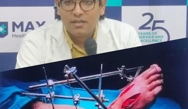 मैक्स हॉस्पिटल ने किया कमाल, कटा हुआ पैर दोबारा जोड़कर बचाई युवक की जिंदगी